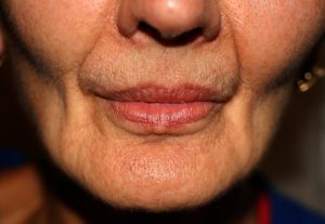 sunken cheek cheeks dentures hollowed face after solve plumpers problems make traditional before