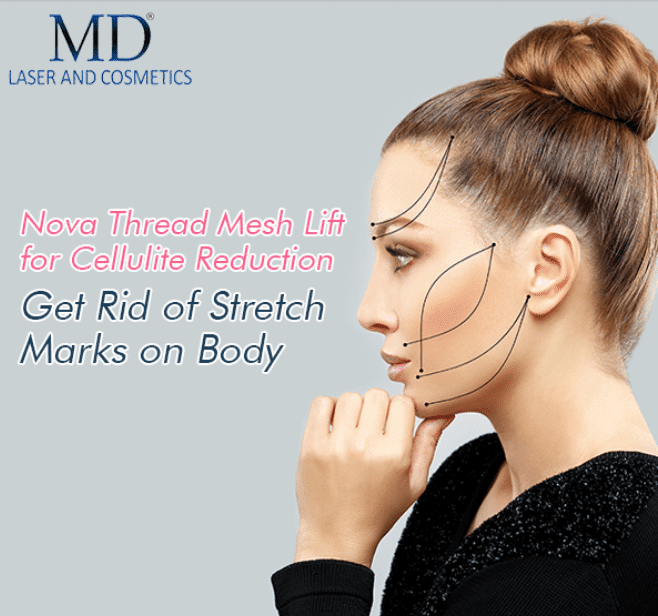 MIcro Lift Threads : Latest Revelation in Face and Body Lift http
