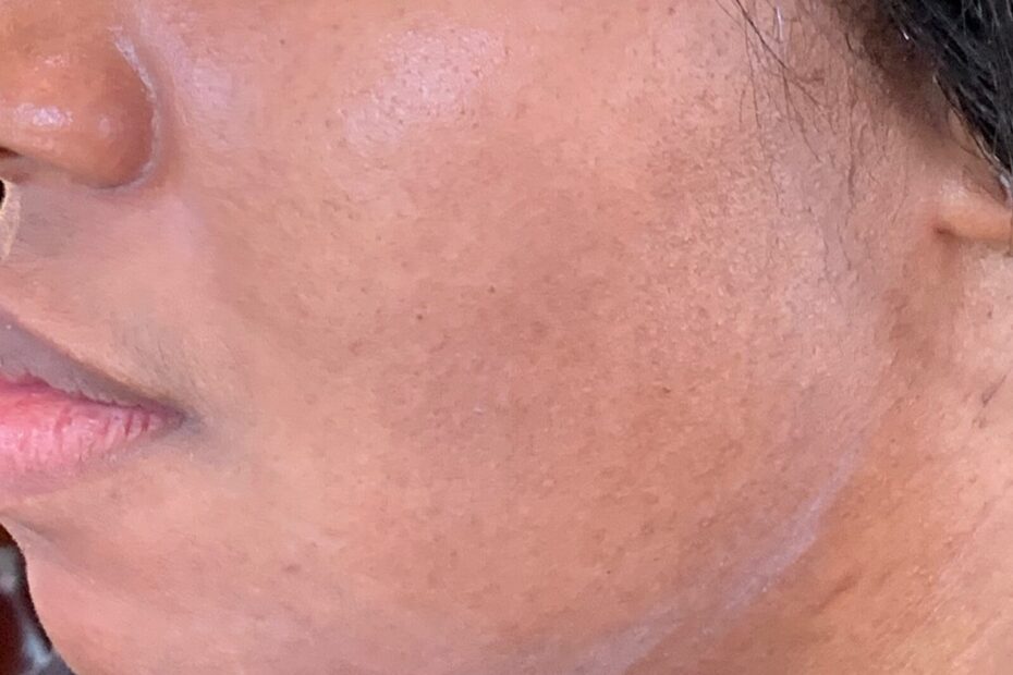 Melasma and skin treatment, MD Laser & Cosmetics San Mateo