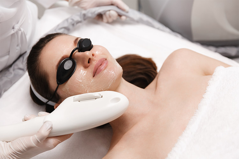 IPL Photofacial Treatment