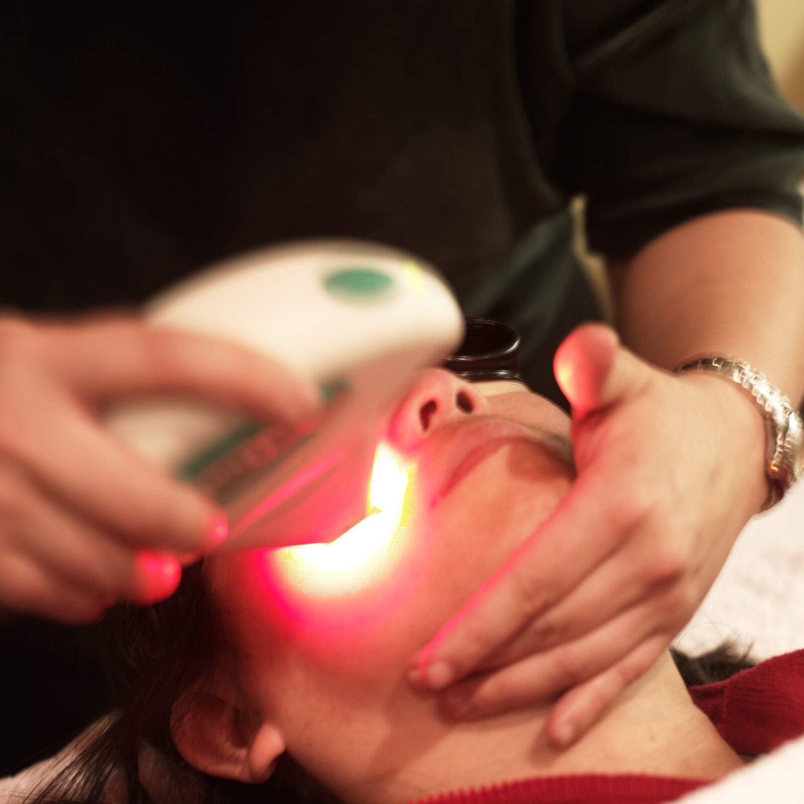 IPL Photofacial in San Mateo