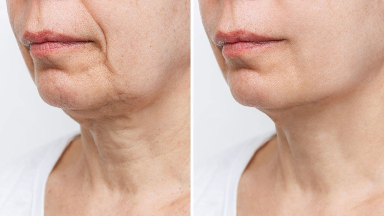 Instalift Threadlift Before & After