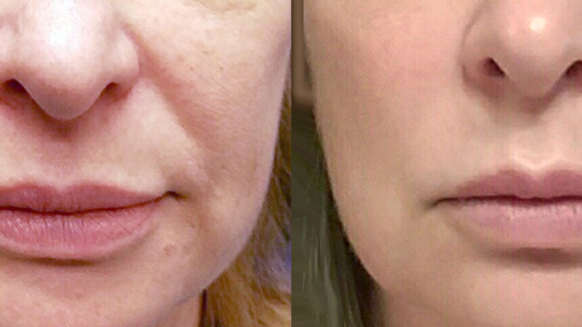 Instalift Threadlift Before & After