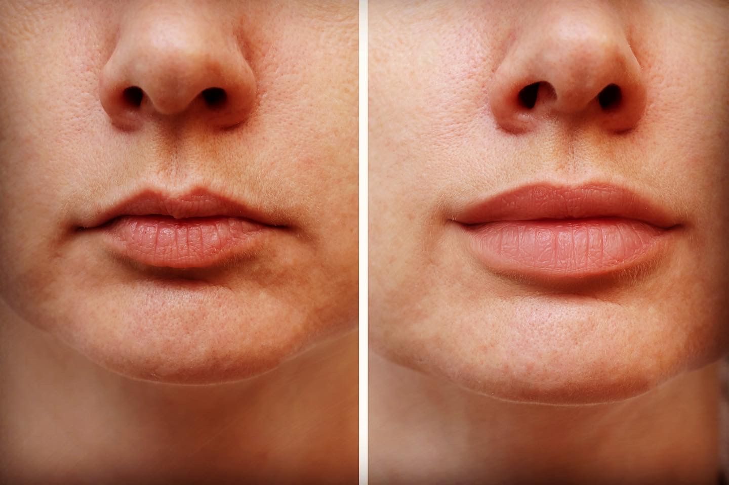 Lip Filler Before & After