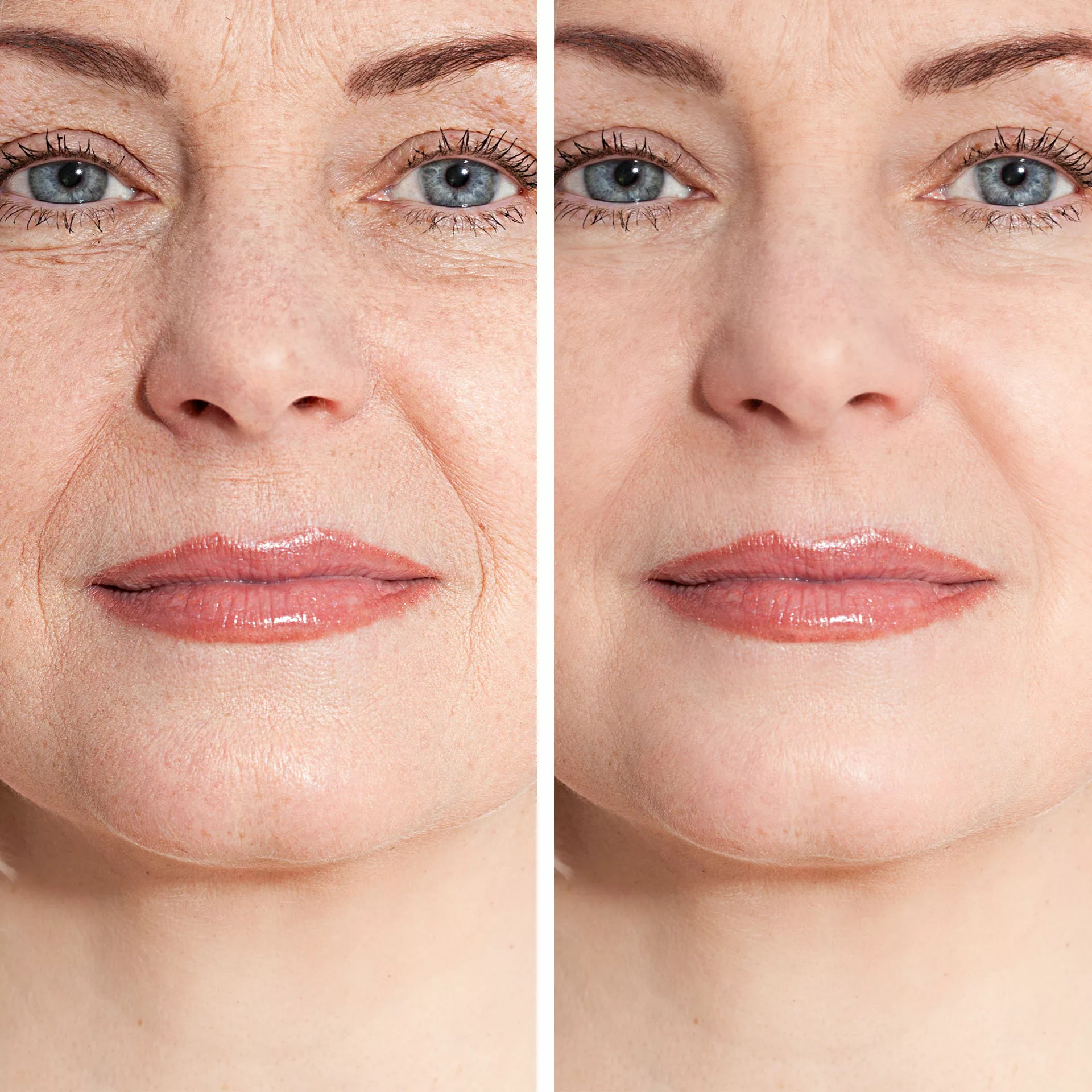 Restylane Before & After