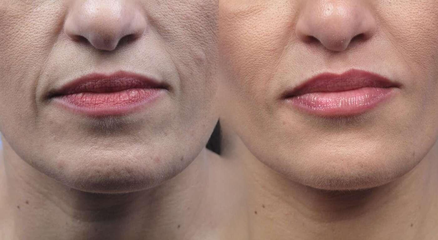 Restylane Before & After