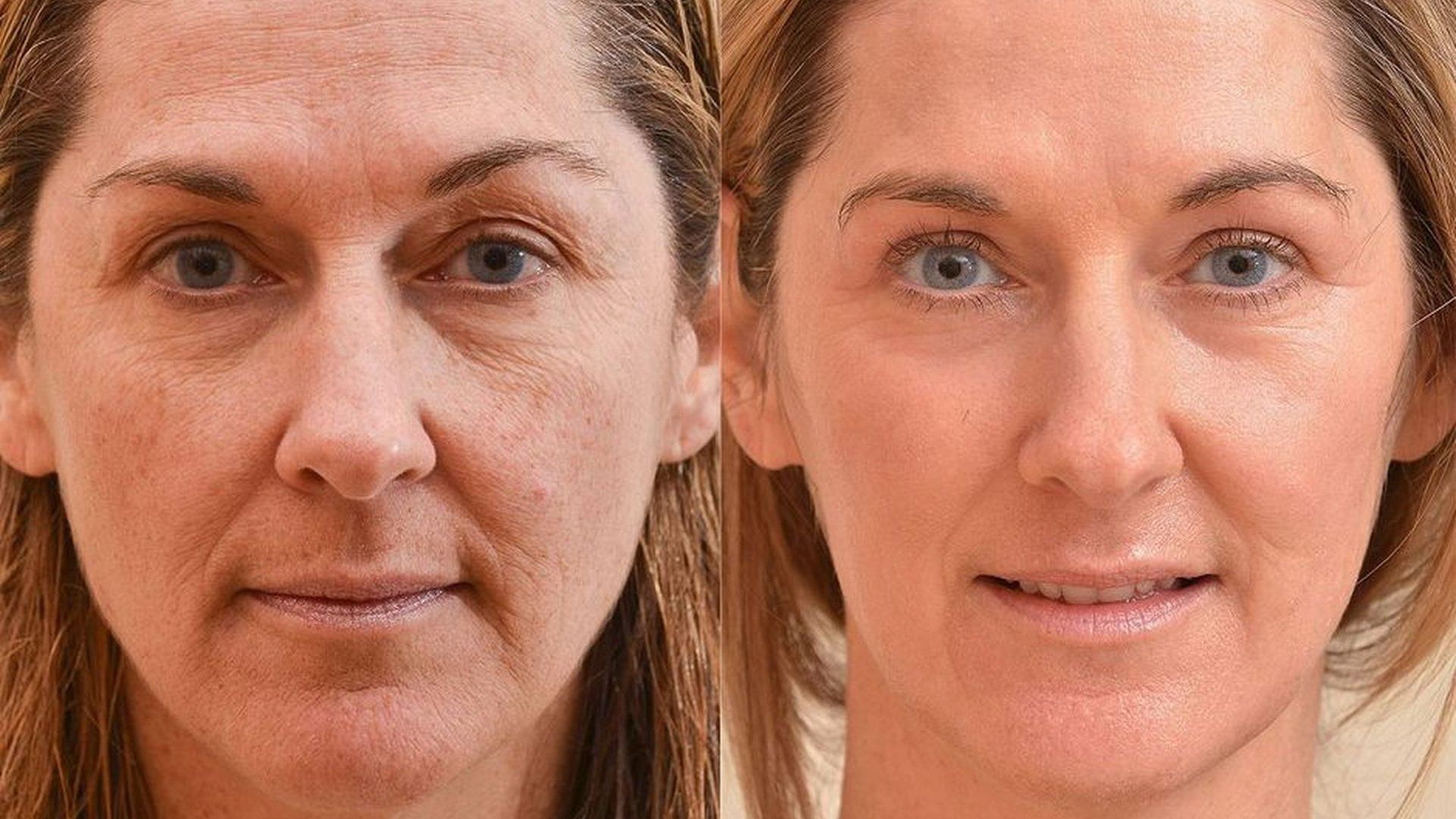 Skin Rejuvenation Before & After