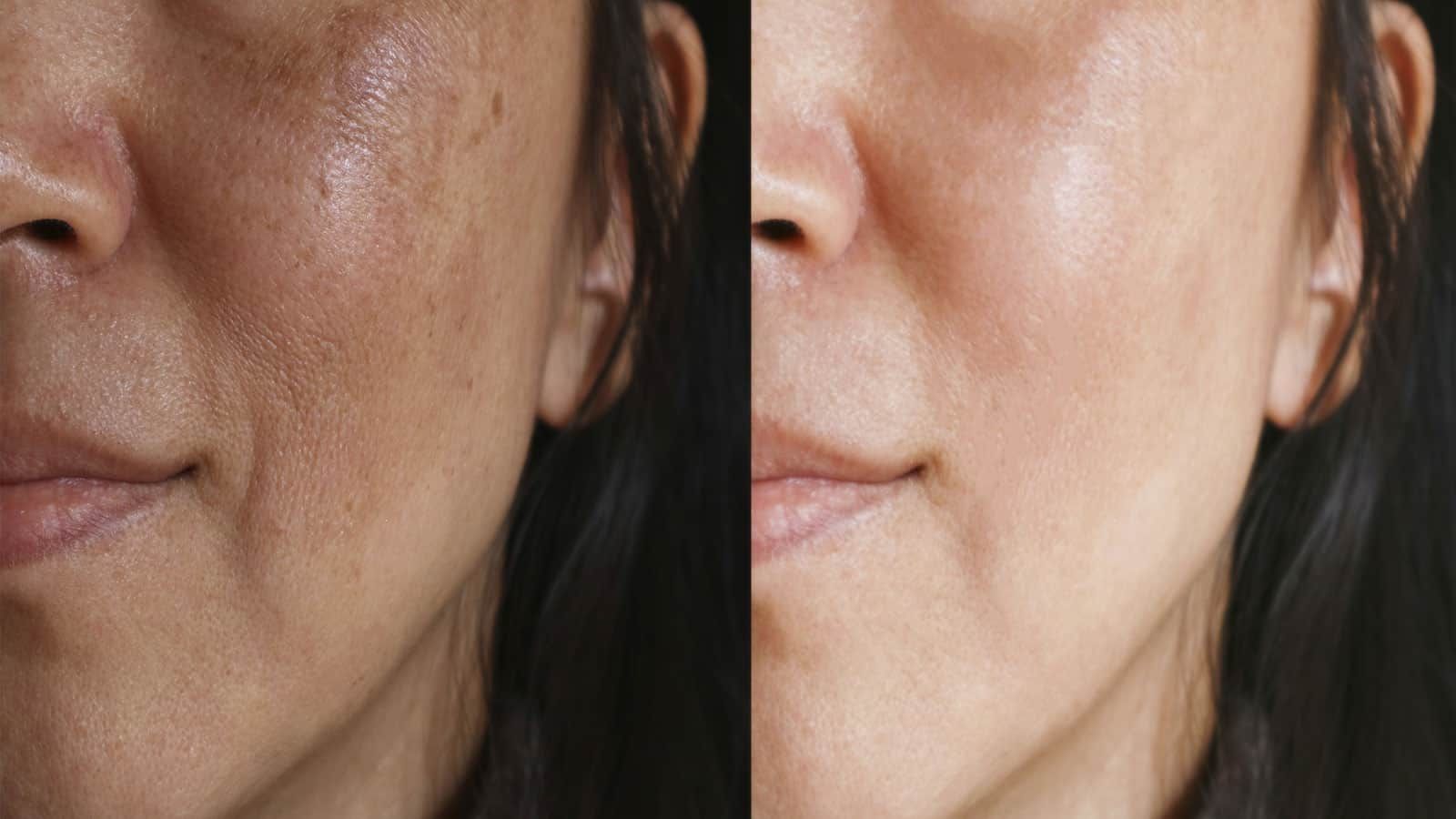 Skin Rejuvenation Before & After