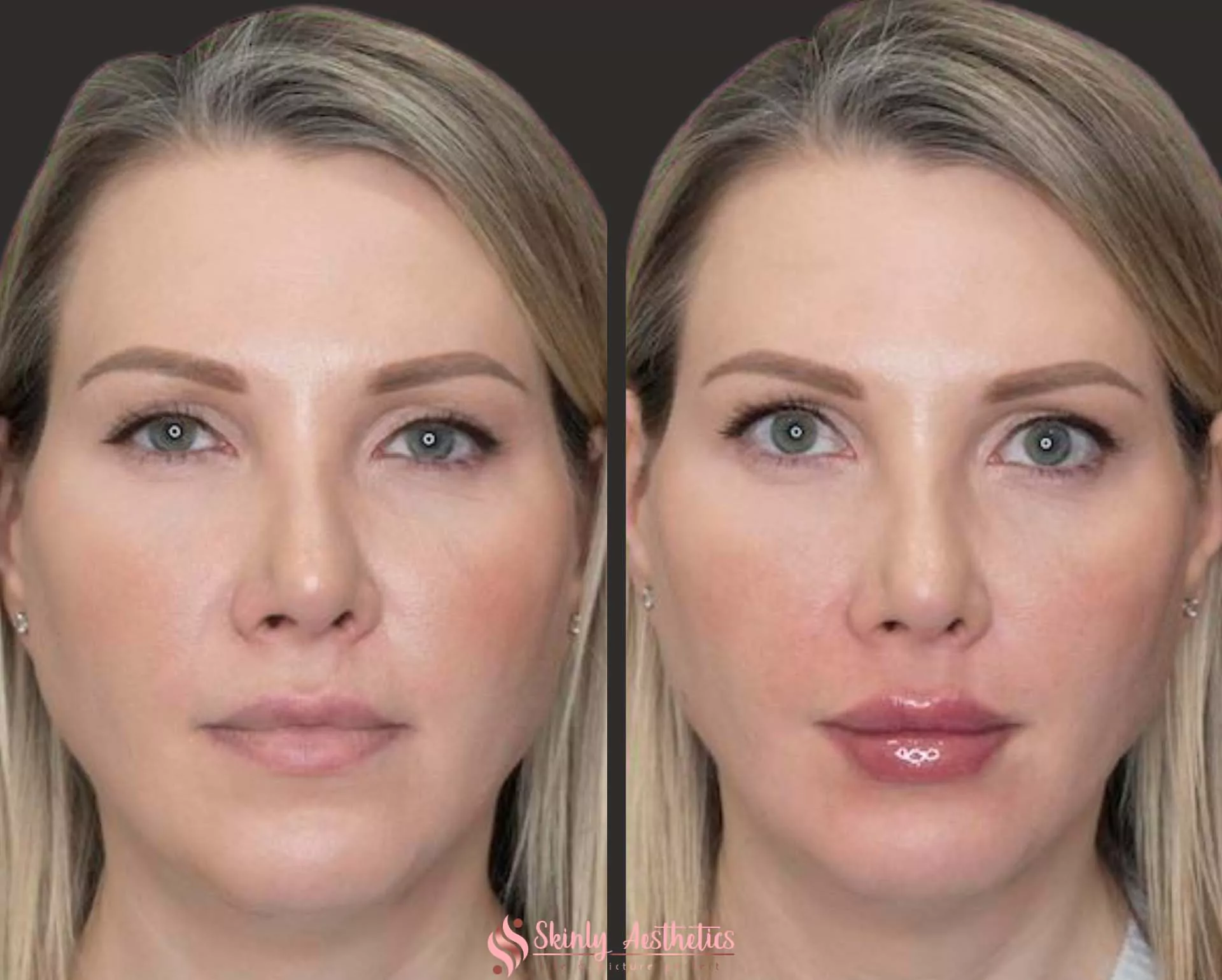 Filler Before & After