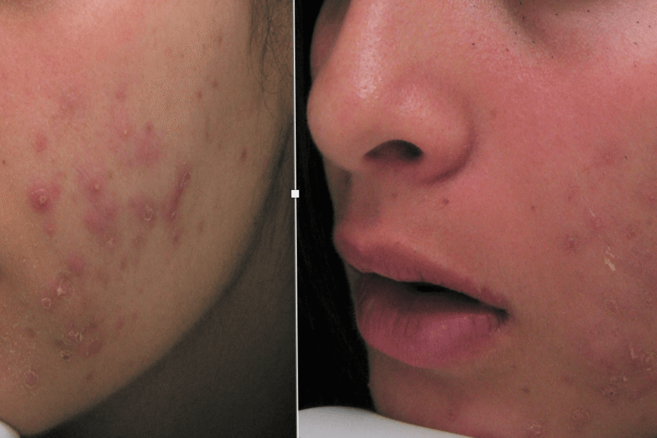 Chemical peel and acne treatment results, San Mateo (individual results vary)