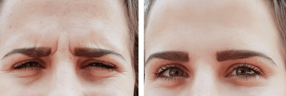 Botox, Dysport and Xeomin wrinkle treatment, San Mateo