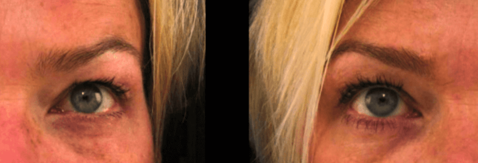 Botox and Dysport results, MD Laser & Cosmetics San Mateo (individual results vary)