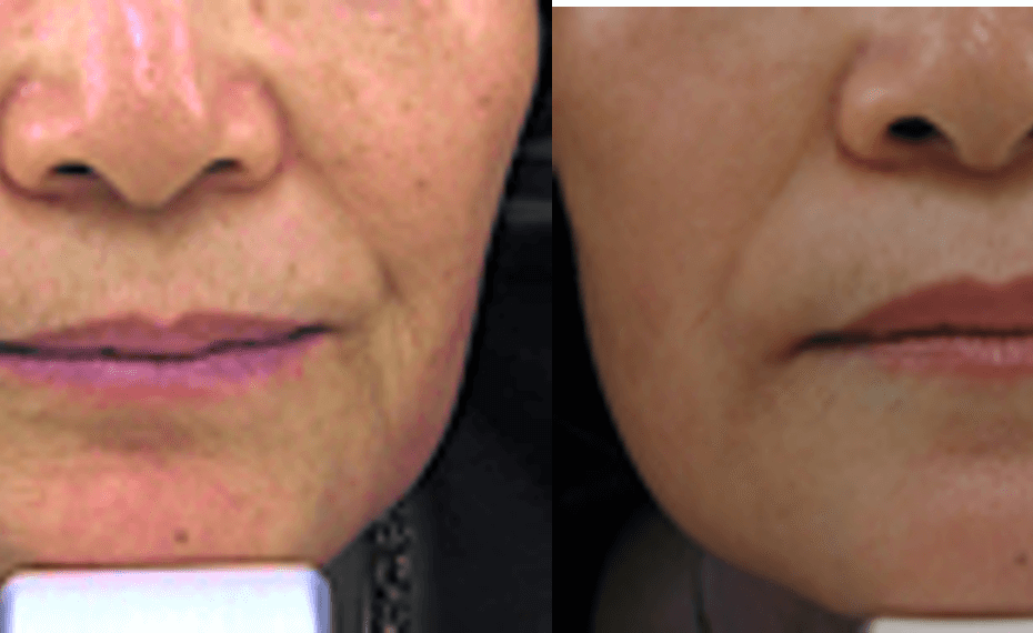 Choosing a physician Botox injector in San Mateo