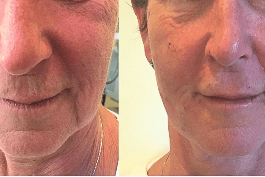 Dermal filler liquid face lift results, San Mateo (individual results vary)