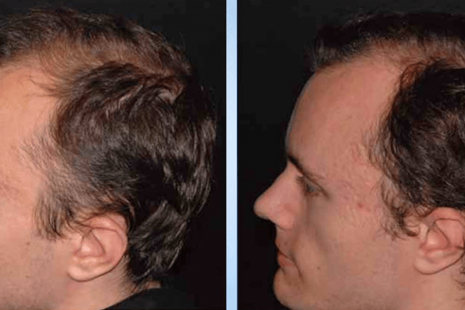 Hair loss treatment results, MD Laser & Cosmetics San Mateo
