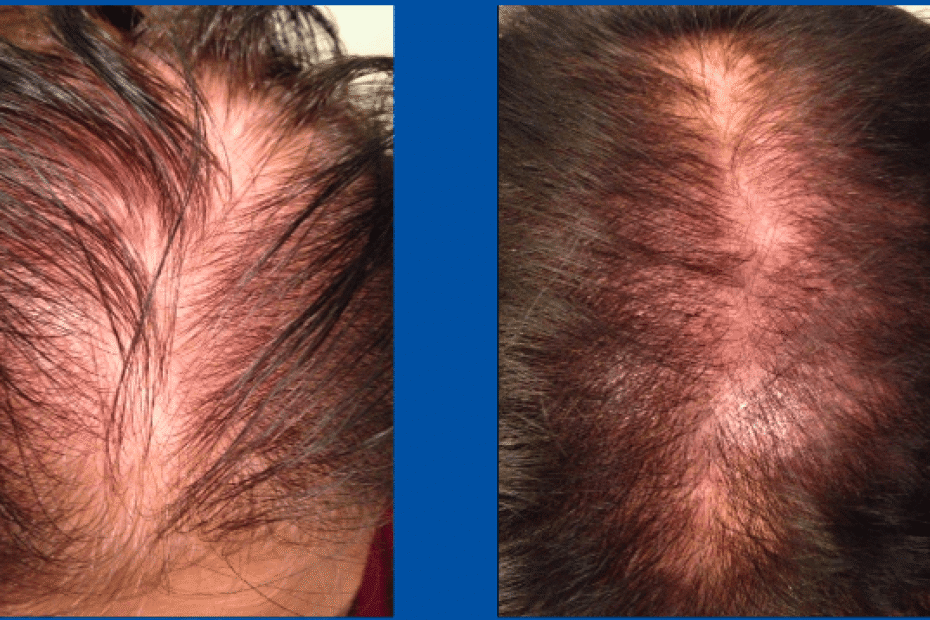 Hairloss treatment