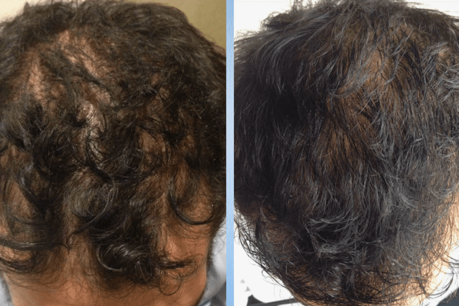 Hairloss treatment