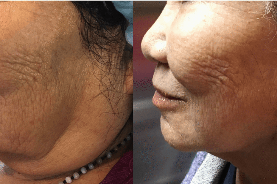 Instalift and jawline contouring, San Mateo