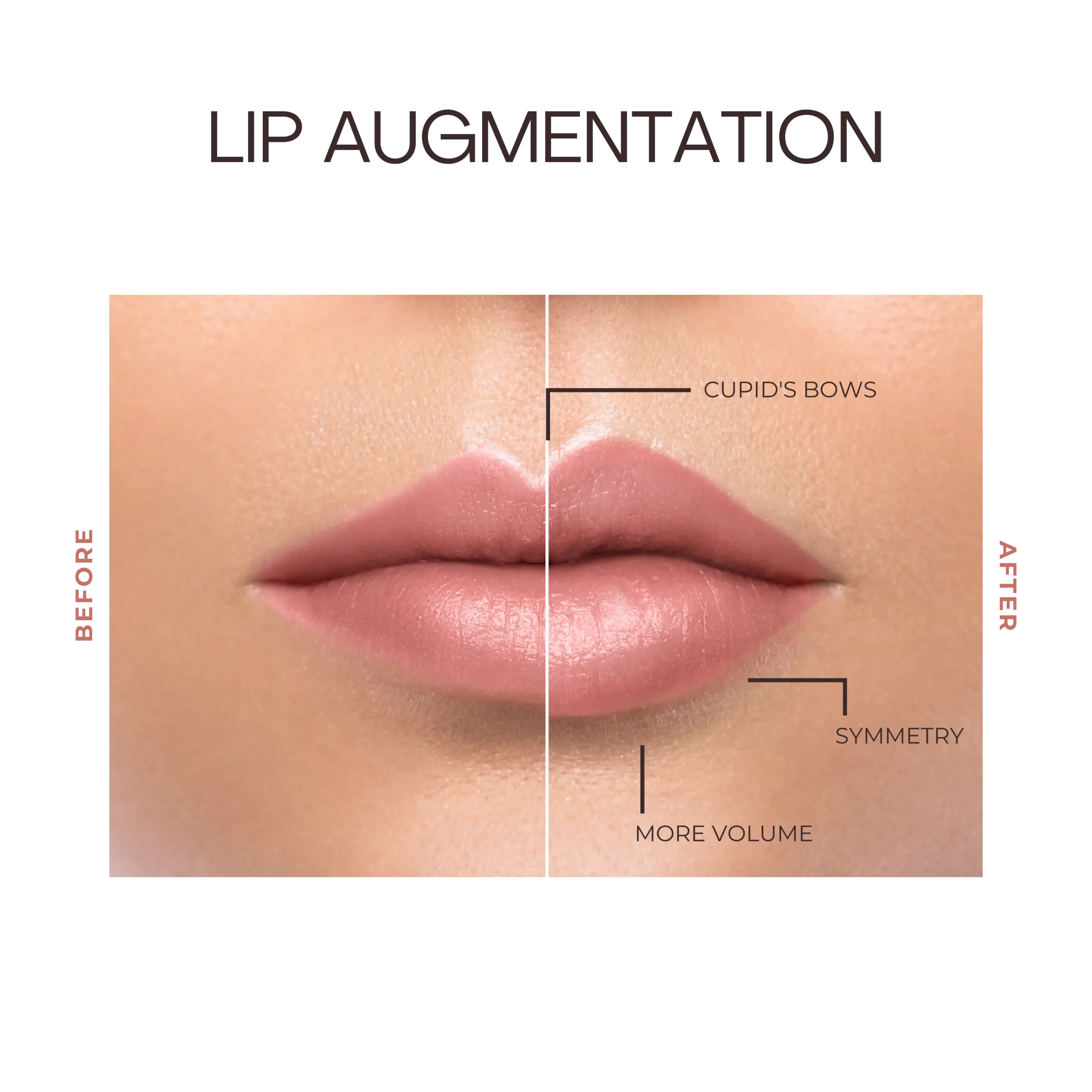 Lip Filler