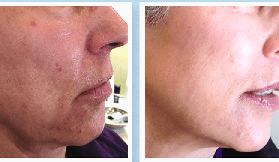 Regenerative skin rejuvenation with PRP and growth factors, San Mateo