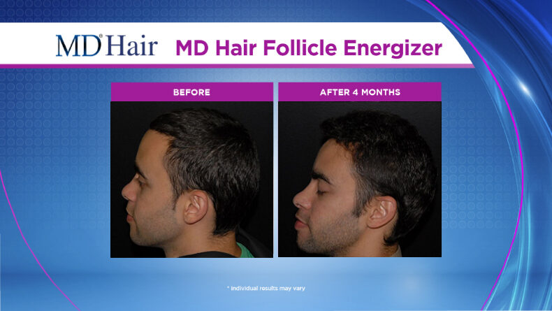 MD Hair Follicle Energizer results - individual results may vary