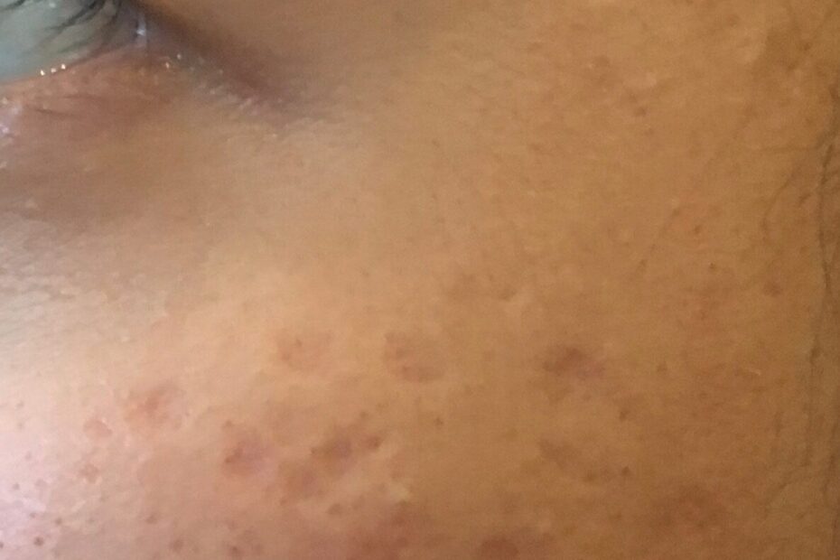 Acne and skin texture treatment, San Mateo