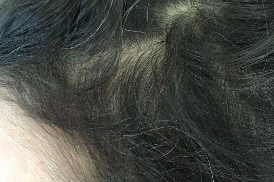 Hair regrowth support during weight loss, San Mateo