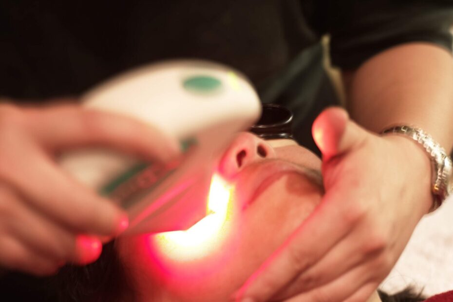 IPL photofacial for hyperpigmentation and brown spots, San Mateo